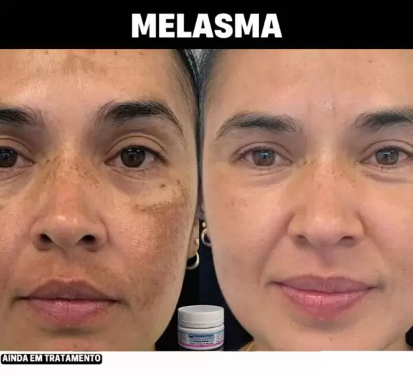 Resultado Antes e Depois do uso de Amazolé Clareador